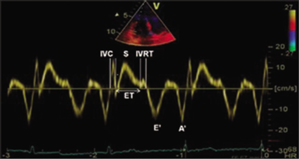 Tissue Doppler imaging of the lateral tricuspid annulus showing measurement of isovolumic contraction time, isovolumic relaxation time, ejection time, tricuspid annular systolic velocity (S), tricuspid annular early (E’) and late diastolic velocities (A’).