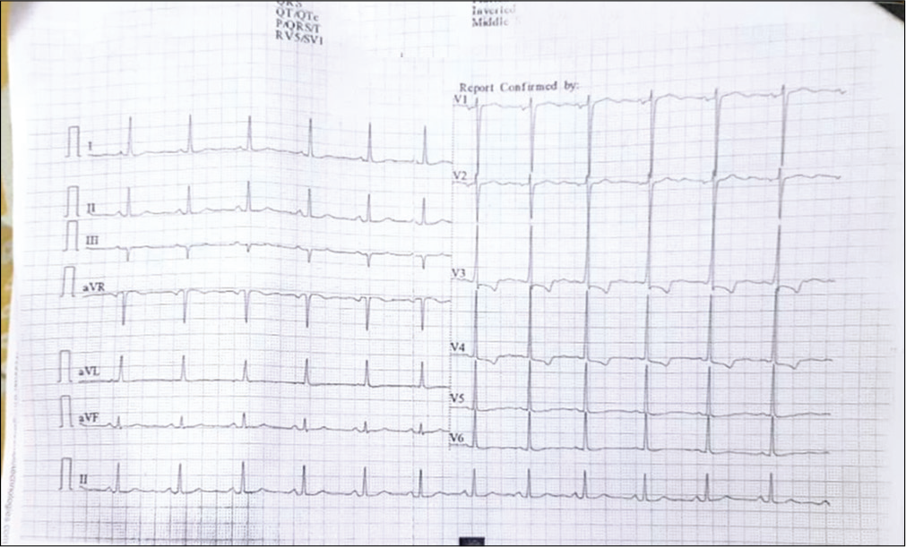 Electrocardiogram on presentation.