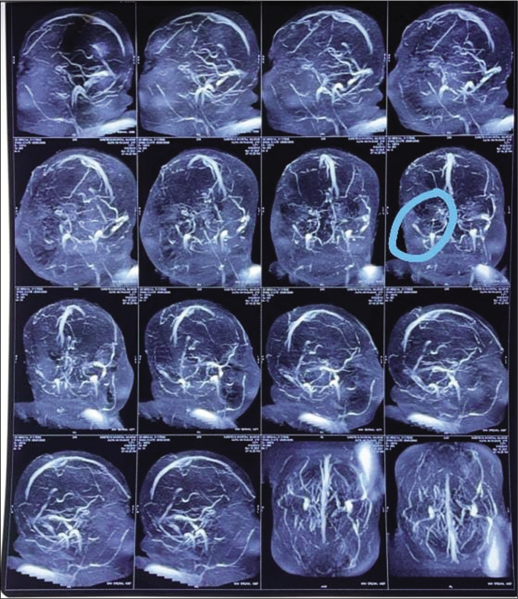 Transverse sinus stenosis (showing on the left side in the circled area).