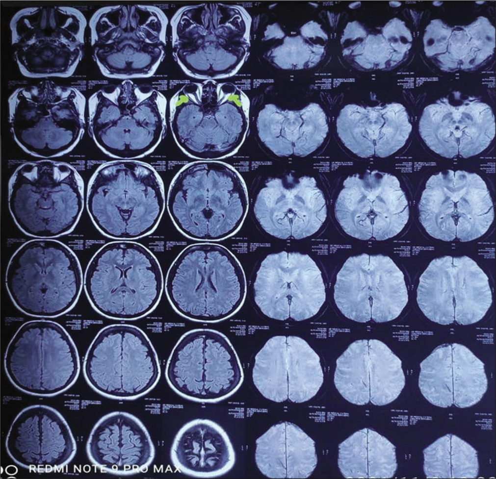 Papilloedema and increased tortuosity of optic nerve.