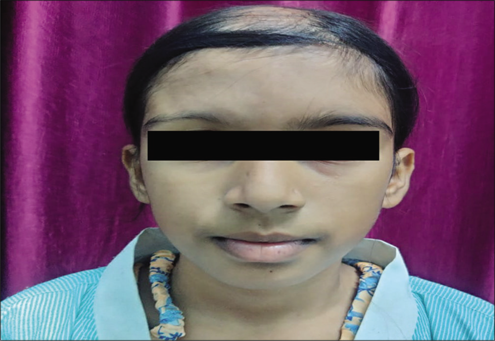 Photograph showing atrophy of the right forehead and sparse eyebrow on the right side.