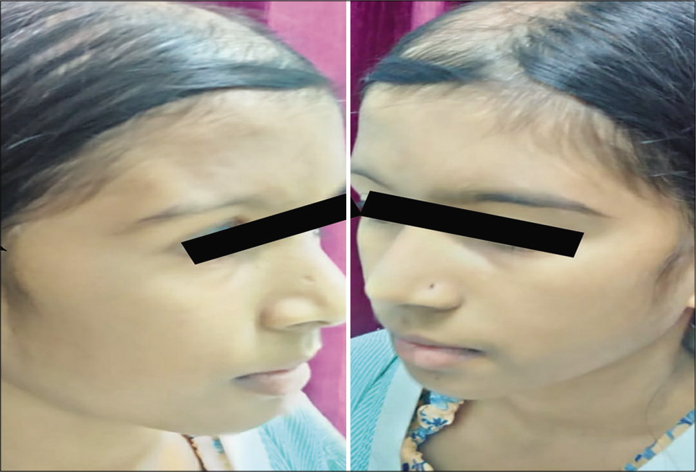 Photograph showing atrophy of forehead and sparse eyebrow on the right side and right-sided alopecia compared to normal left side.