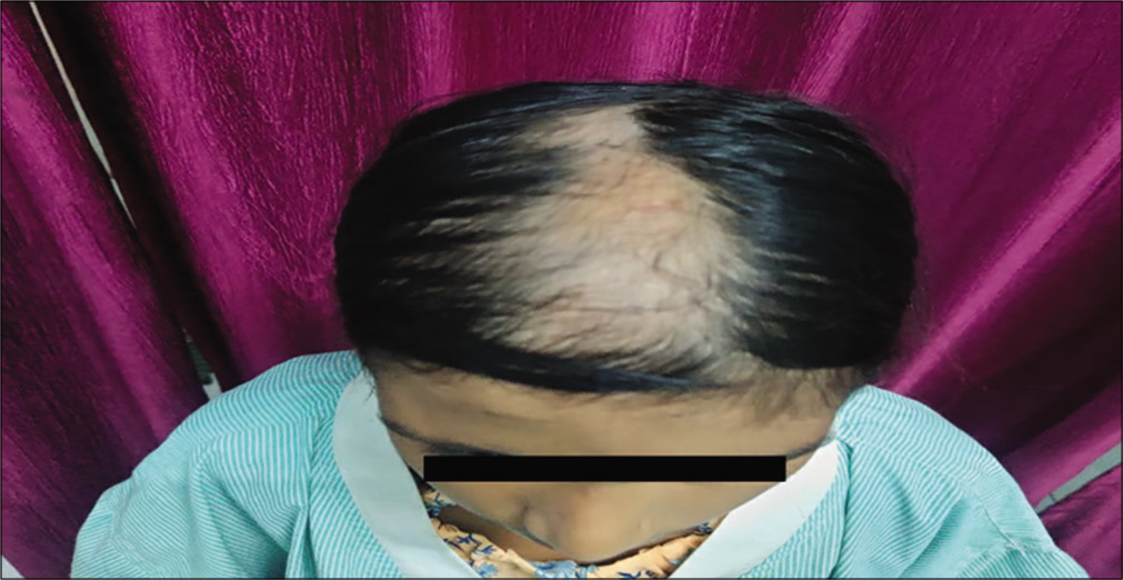 Photograph showing alopecia limited to the right side with sparing of the left side.