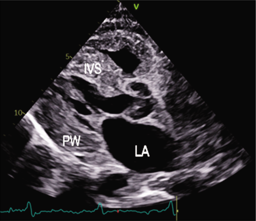 PLAX view 2D echo showing thickened IVS.