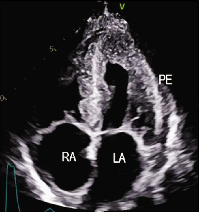 Apical four-chamber view showing granular sparkling myocardium.