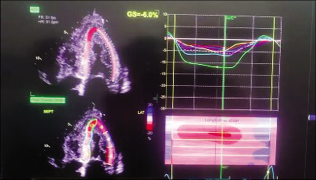 Strain 2D echo showing speckle tracking and apical sparing.