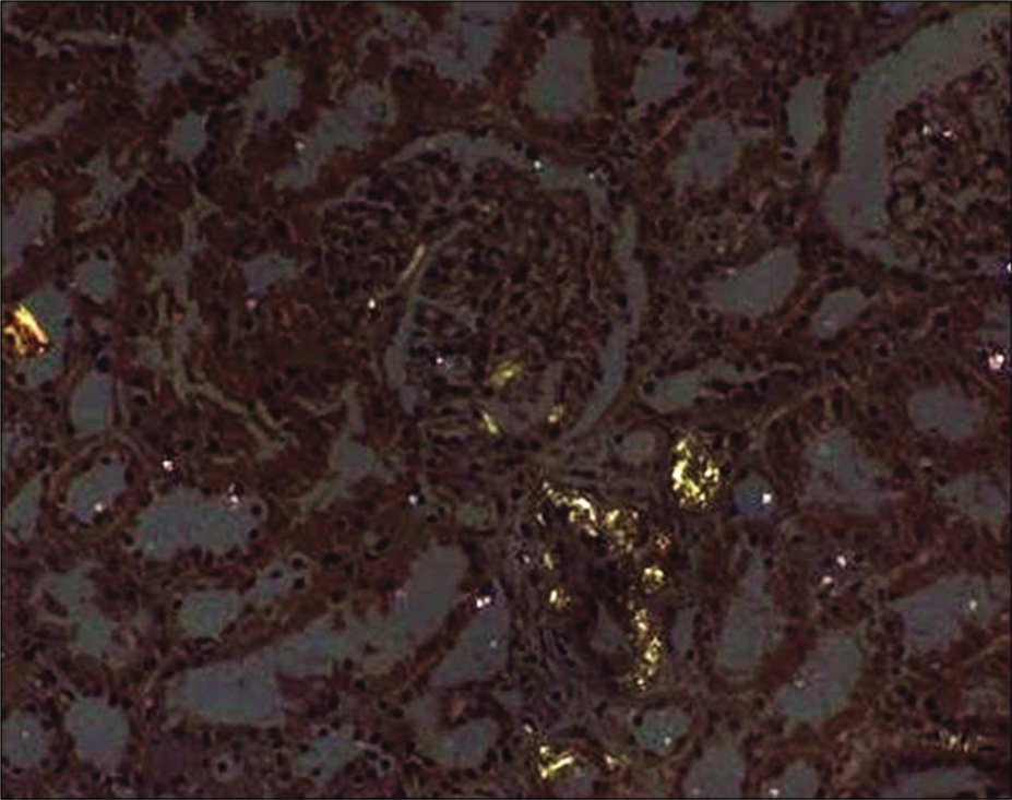 Kidney biopsy showing Congo red staining.