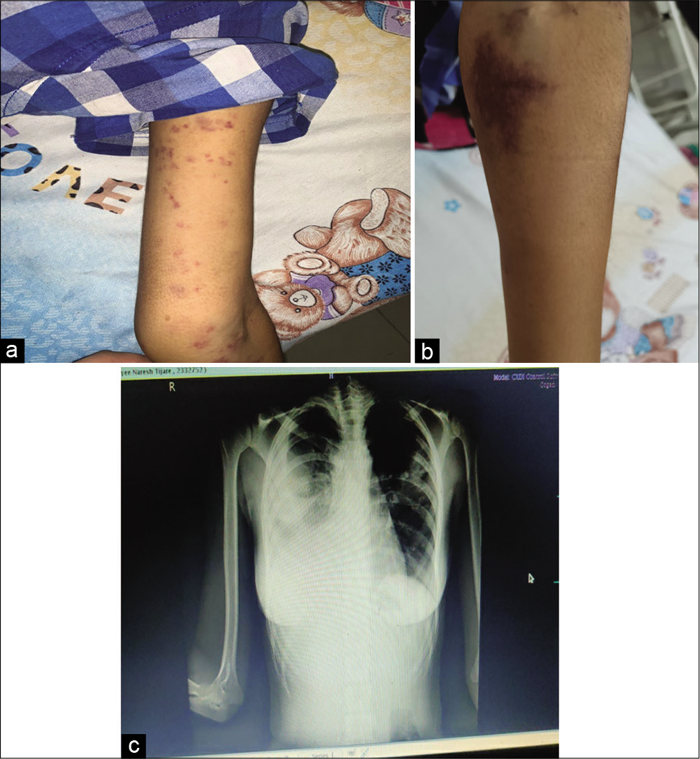 (a) Petechiae on arm. (b) Ecchymotic patch on forearm. (c) X-ray suggestive of pleural effusion.