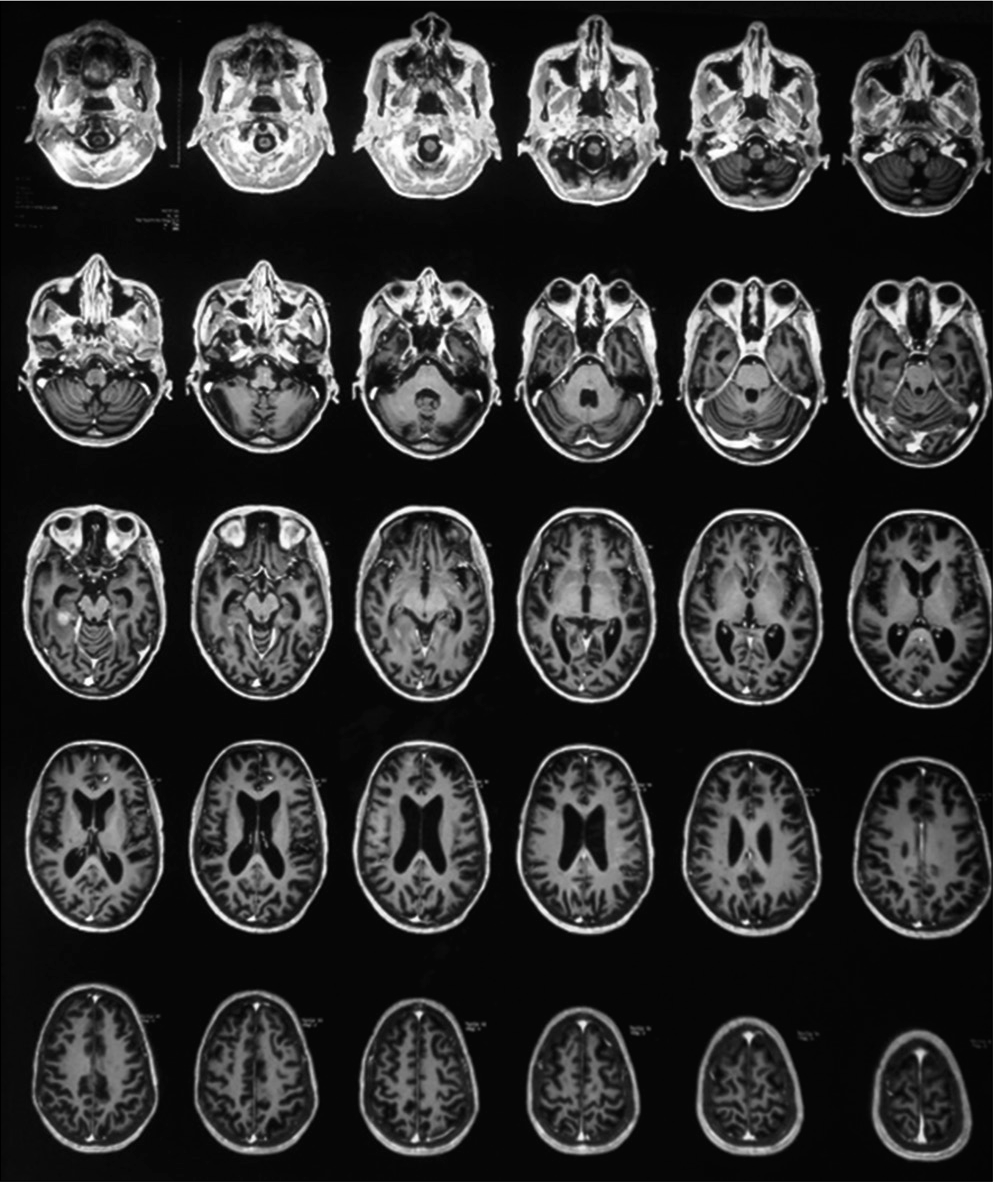 Bilateral frontoparietal acute infarcts and hyperintensity over the right temporoparietal region.