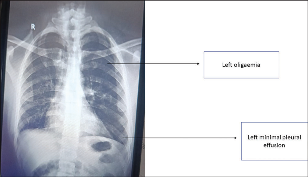 Case 2 – Chest X-ray suggestive of the left oligaemia and left minimal pleural effusion.