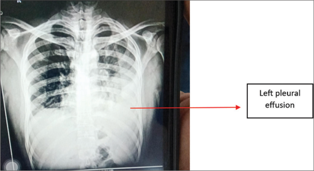 Case 3 – Chest X-ray suggestive of the left pleural effusion.