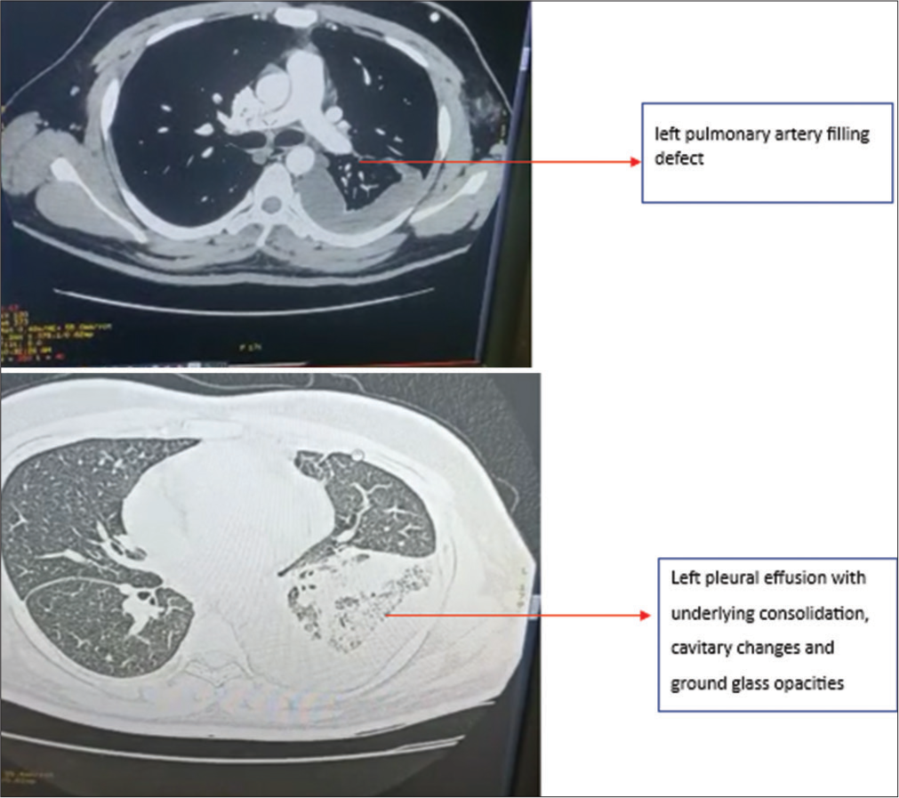 Case 3 – Computed tomography pulmonary angiogram suggestive of the left pulmonary artery filling defect and left pleural effusion with underlying consolidation, cavitary changes and ground-glass opacities.