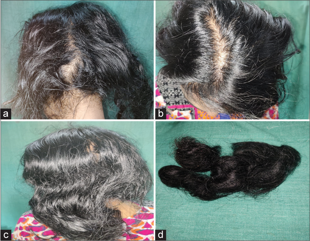 (a) Diffuse thinning of hair in a treated case of idiopathic thrombocytopenic purpura on occiput, (b) vertex, (c) parietal aspect, (d) bunch of hairs collected by patient.
