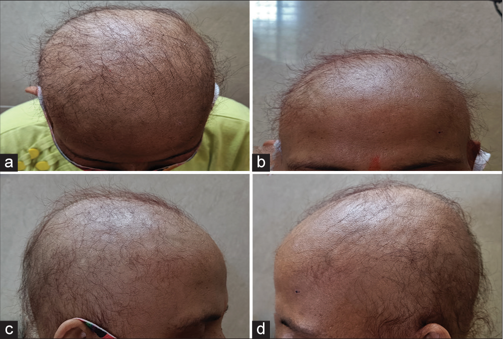Alopecia in a case of optic neuritis treated on azathioprine as seen on (a) vertex, (b) frontal, (c) and (d) parietal aspect of each side.