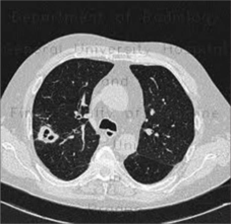 High-resolution computed tomography (HRCT) chest image showing multiple cavitary lesions and ground-glass opacities.