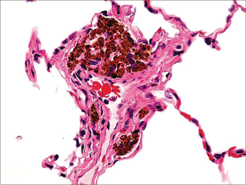 Histopathology showing Langhans giant cells and inflammatory infiltrates.