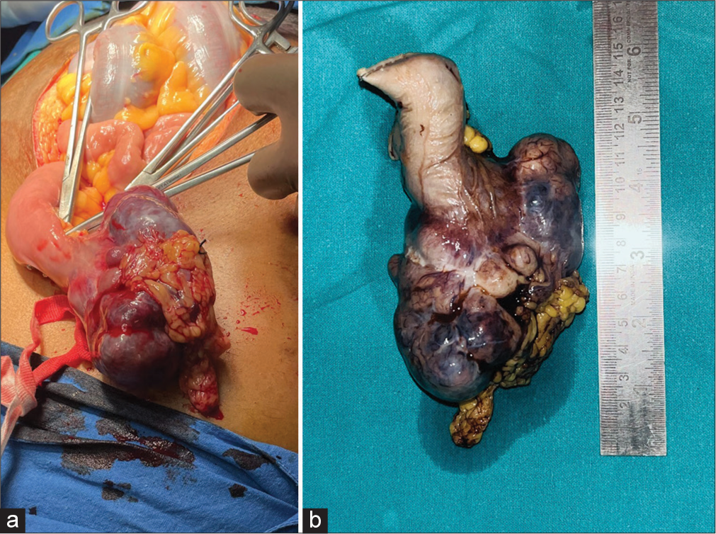 (a) Intraoperative image and (b) resected specimen showing tumour arising from jejunum measuring 12 × 7 × 5 cm.