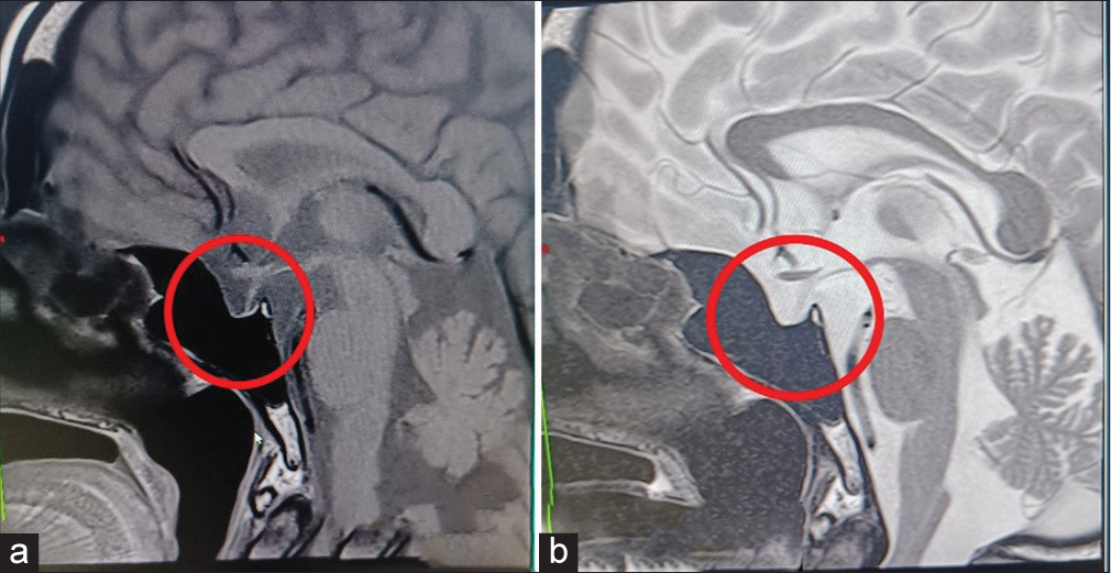 Magnetic resonance imaging (MRI) scan of the brain (a) showing T1 and (b) T2 images (11 March 2023) showing empty sella (red circles).