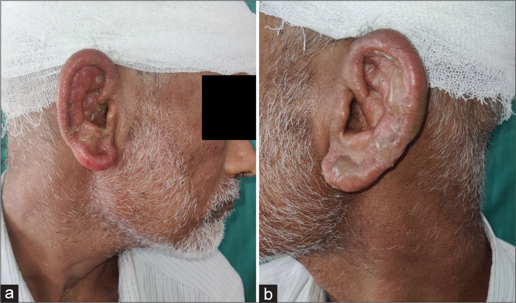 (a and b) Clinical examination showing diffuse tender oedematous, erythema with a few vesicles on bilateral ear pinna (Milian’s ear sign positive) of the right and left ear, respectively.