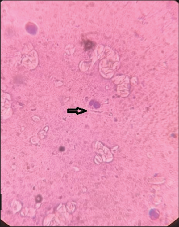 Tzanck smear showed neutrophils with no multinucleated giant cells (on 10× microscopy with black arrow).