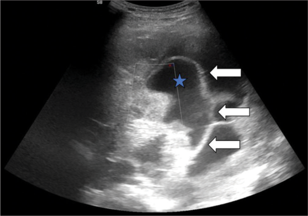 Ultrasonography of the thorax showing pleural fluid (blue star) with multiple septa (white arrows).