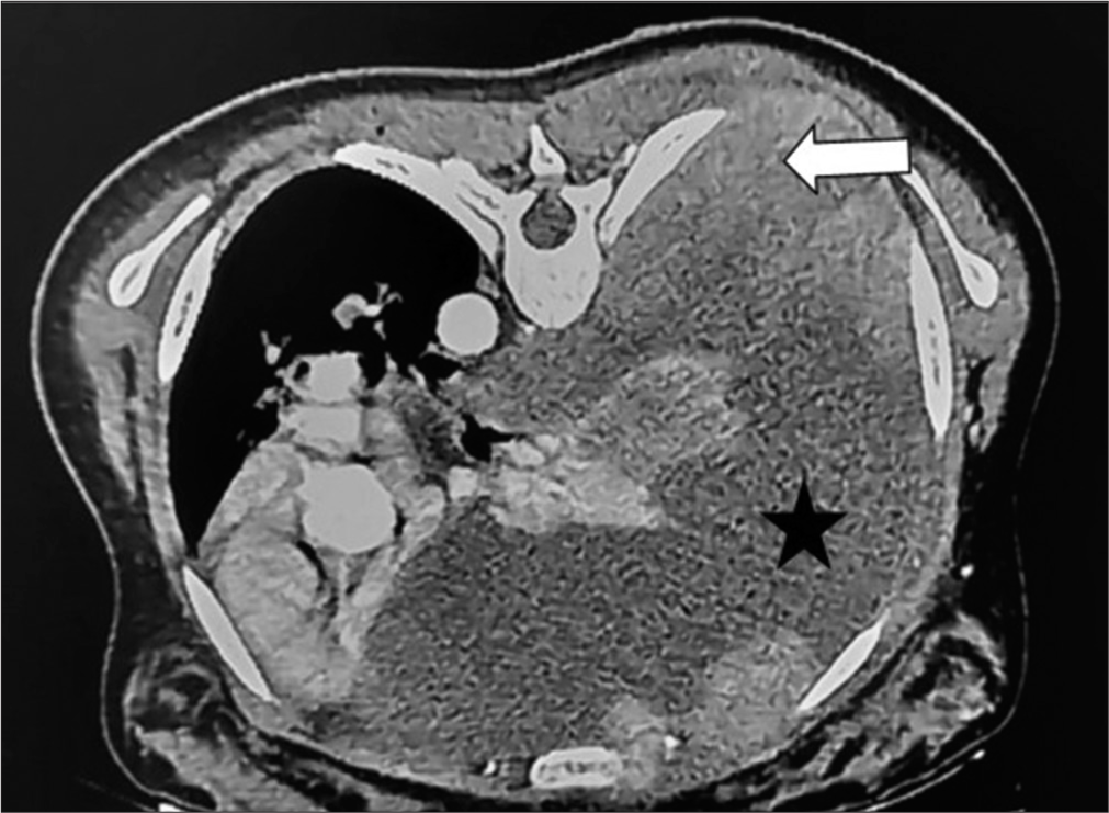 Contrast-enhanced computed tomography thorax showing nodular and thickened right pleura (white arrow) with a gross right pleural collection (star shaped).