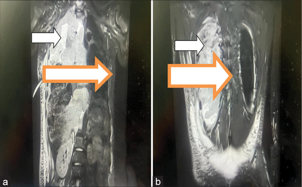 (a and b) Magnetic resonance imaging scan of the thorax (sagittal section): pleural thickening (white arrow), Intercostal drainage tube seen in situ in 5th intercostal space with its tip towards the apical segment of the right upper lobe (4a).