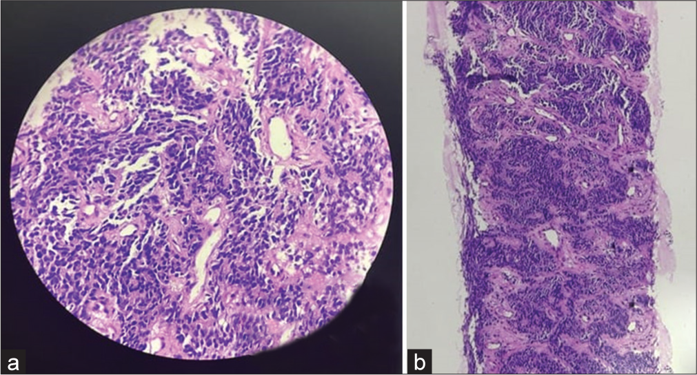 (a and b) Histopathology showing malignant small round blue cells.