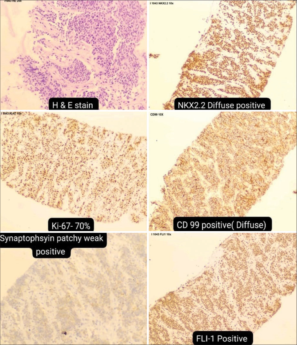 Immunohistochemistry markers indicating Ewing’s sarcoma. H & E: Hematoxylin and eosin staining, NKX2.2: NK2 homeobox 2, Ki-67: Antigen Kiel 67, CD-99: cluster of differentiation 99, FLI-1: Friend leukemia integration 1.