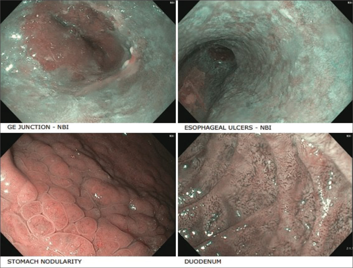 First endoscopy. GE junction: Gastro-intestinal junction, NBI: Narrow band imaging.