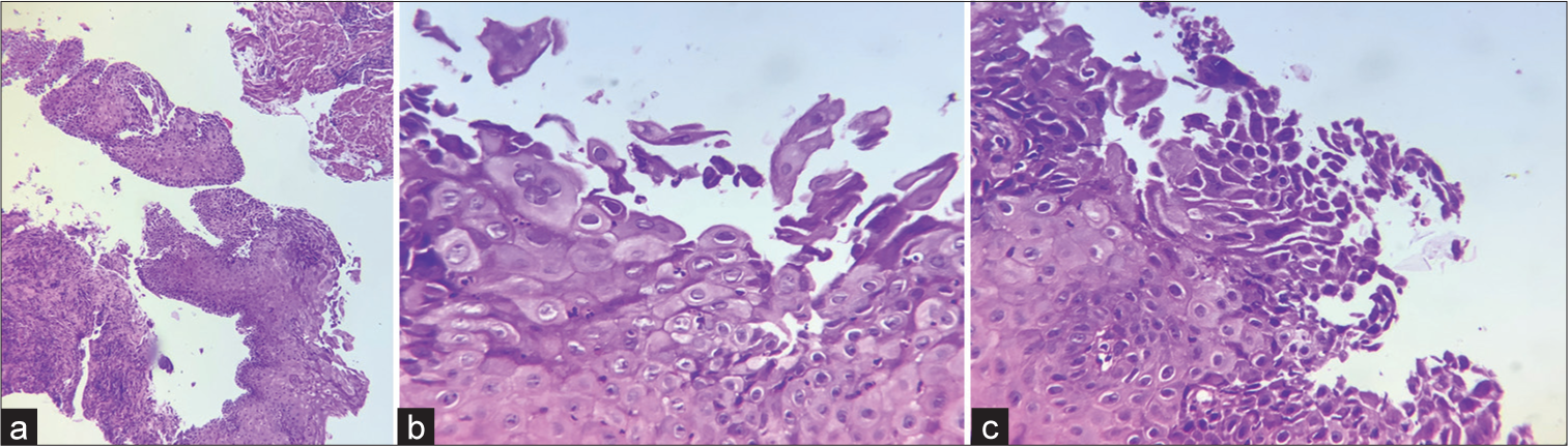 (a-c) Biopsy histopathological examination slides.