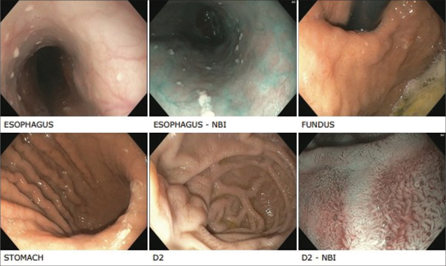 Review endoscopy. NBI: Narrow band imaging, D2: 2nd part of the duodenum.