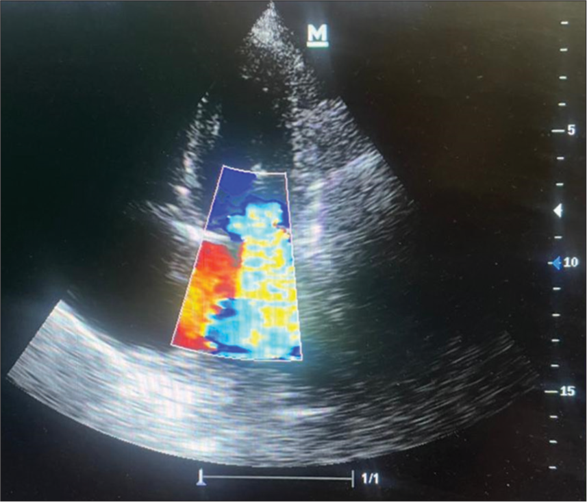 Echocardiography showing severe mitral regurgitation in apical four-chamber view.