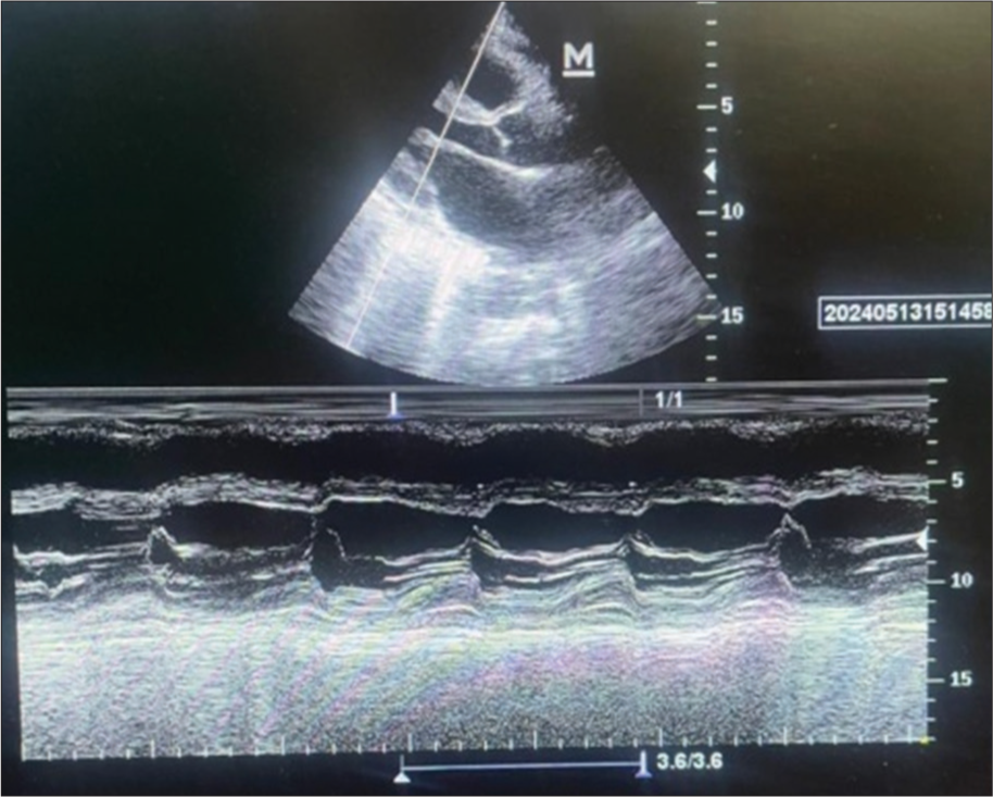 Plax view in 2D echocardiography showing normal left ventricle volumes and function.