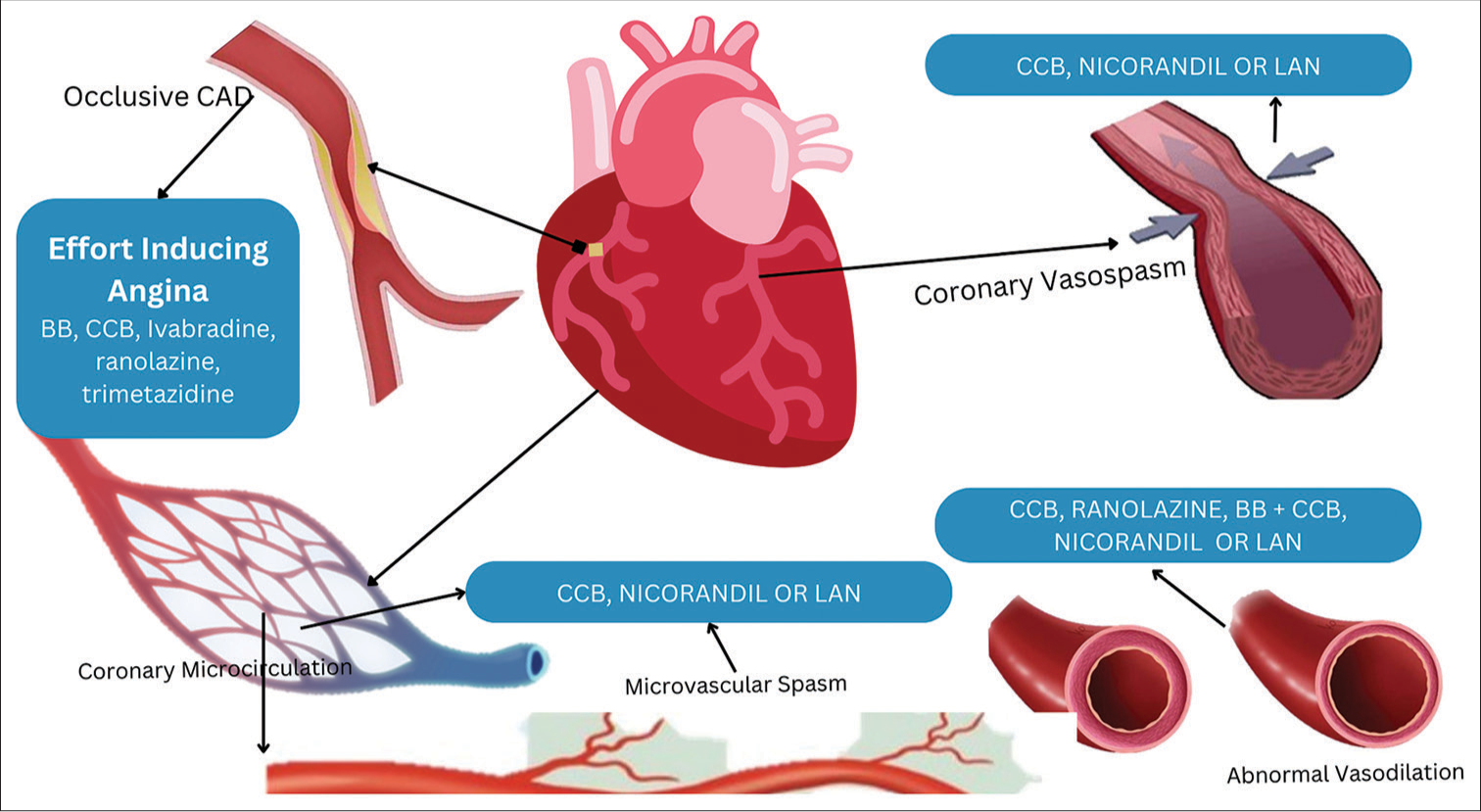 Clinical pathway of anti-anginal treatment. CAD: coronary artery disease, BB: beta blockers, CCB: calcium channel blockers, LAN: long-acting nitrates.